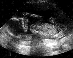 ultrasound of baby at 18 weeks - sucking thumb