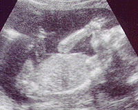 ultrasound at 23 weeks - thumb sucker!