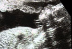 profile ultrasound - 25 weeks