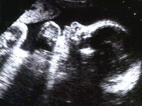 ultrasound at 30 weeks