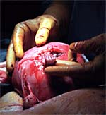 picture of Samuel Armas during fetal surgery