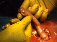 Life Magazine picture of the year - Sara Switzer during fetal surgery